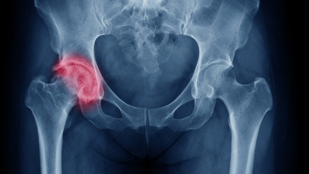Lack of knowledge on osteoporosis is widespread, may lead to undertreatment, investigators find